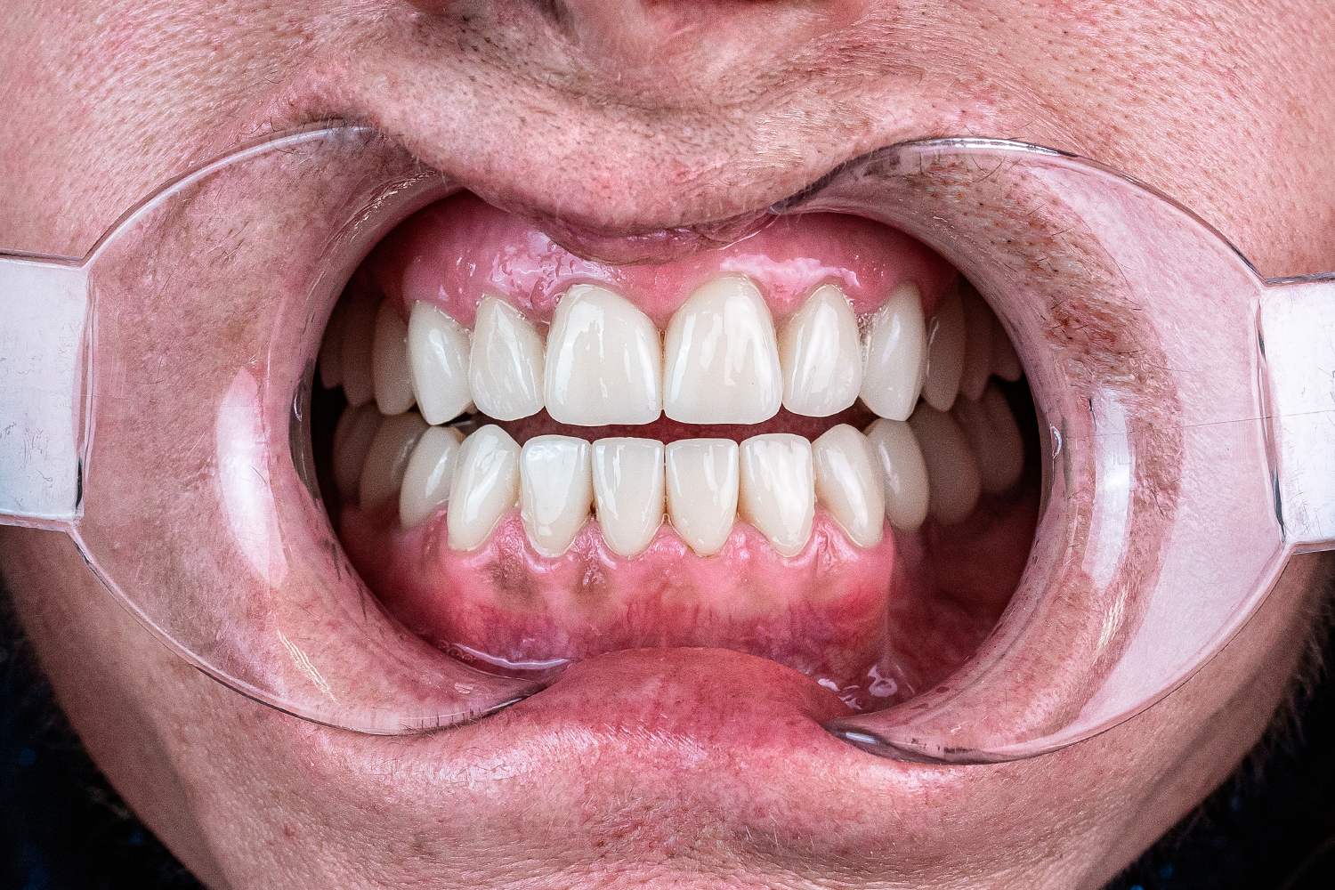 Імплантація та протезування коронками e.max