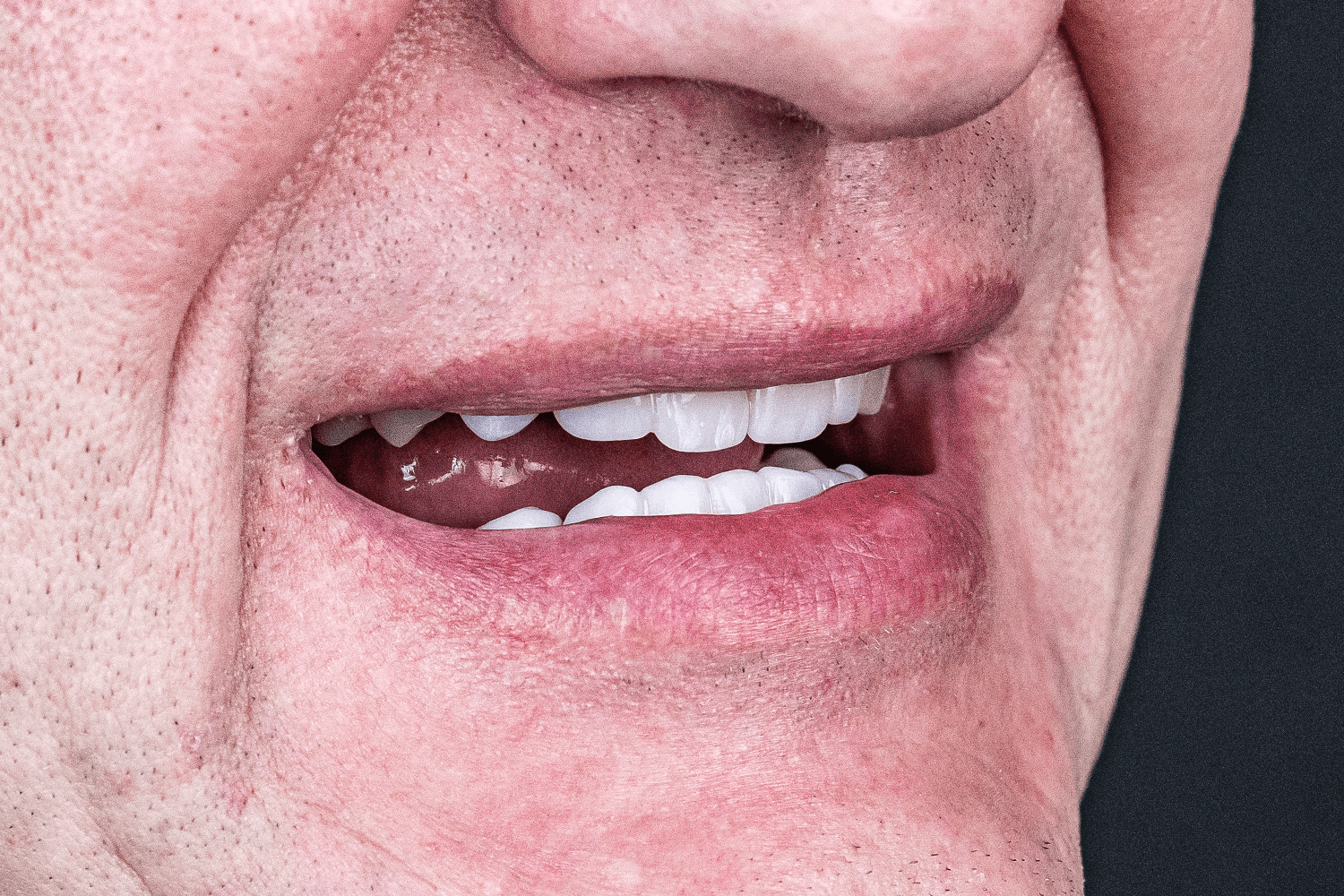 Замінили металокерамічні мости на цирконієві