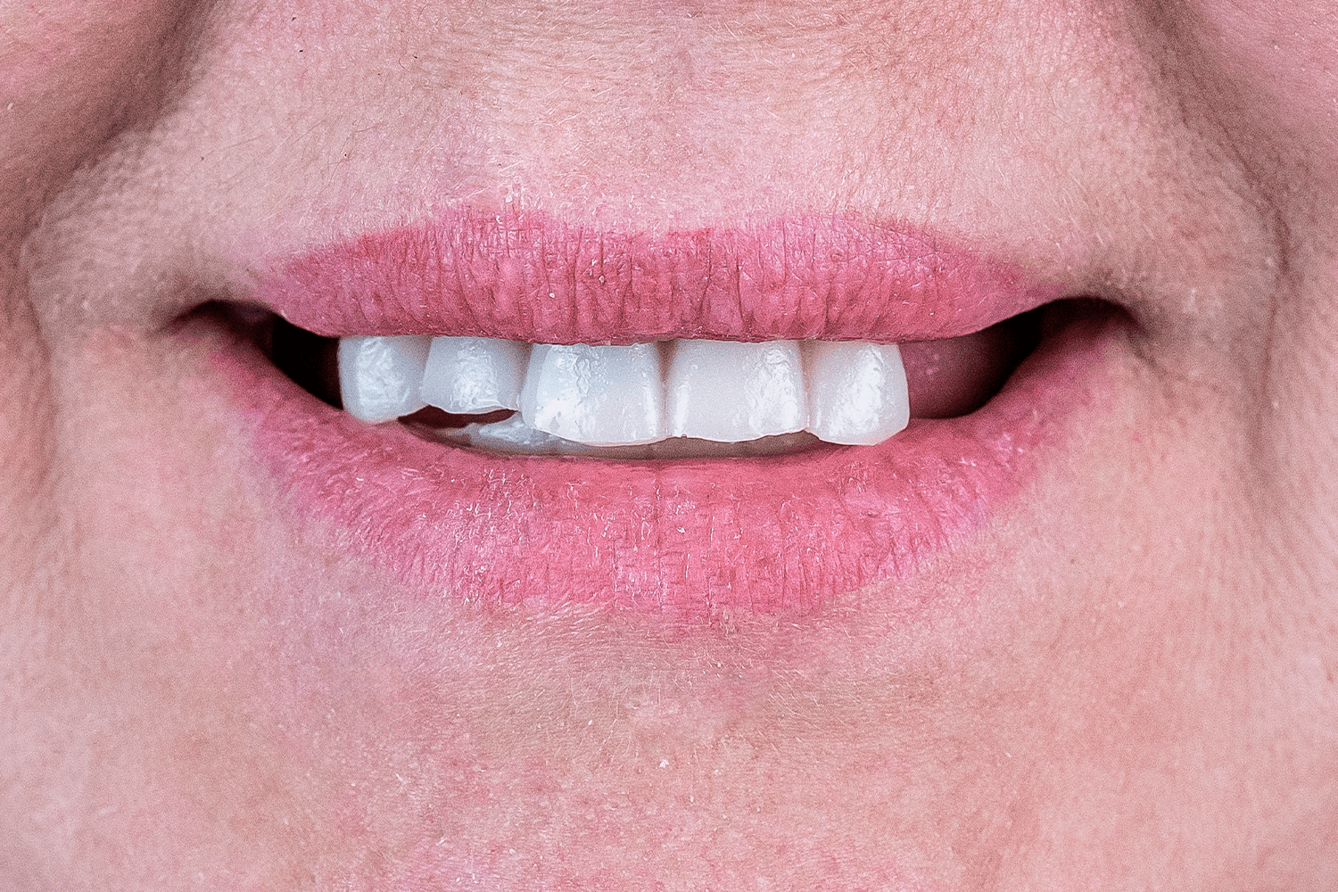 Імплантація та протезування при пародонтиті