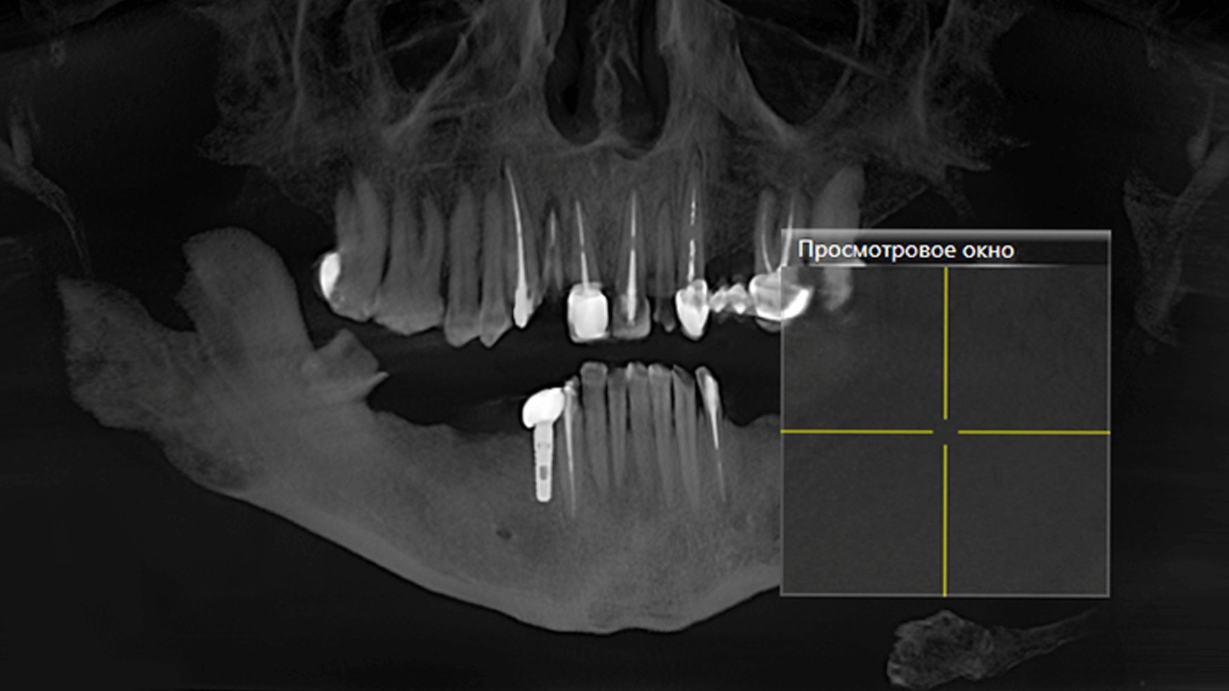 Замінили металокерамічні мости на цирконієві