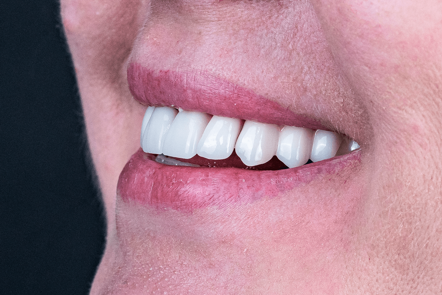 Імплантація та протезування при пародонтиті