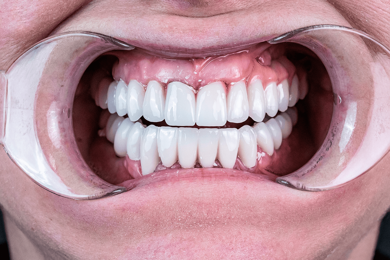 Імплантація та протезування при пародонтиті