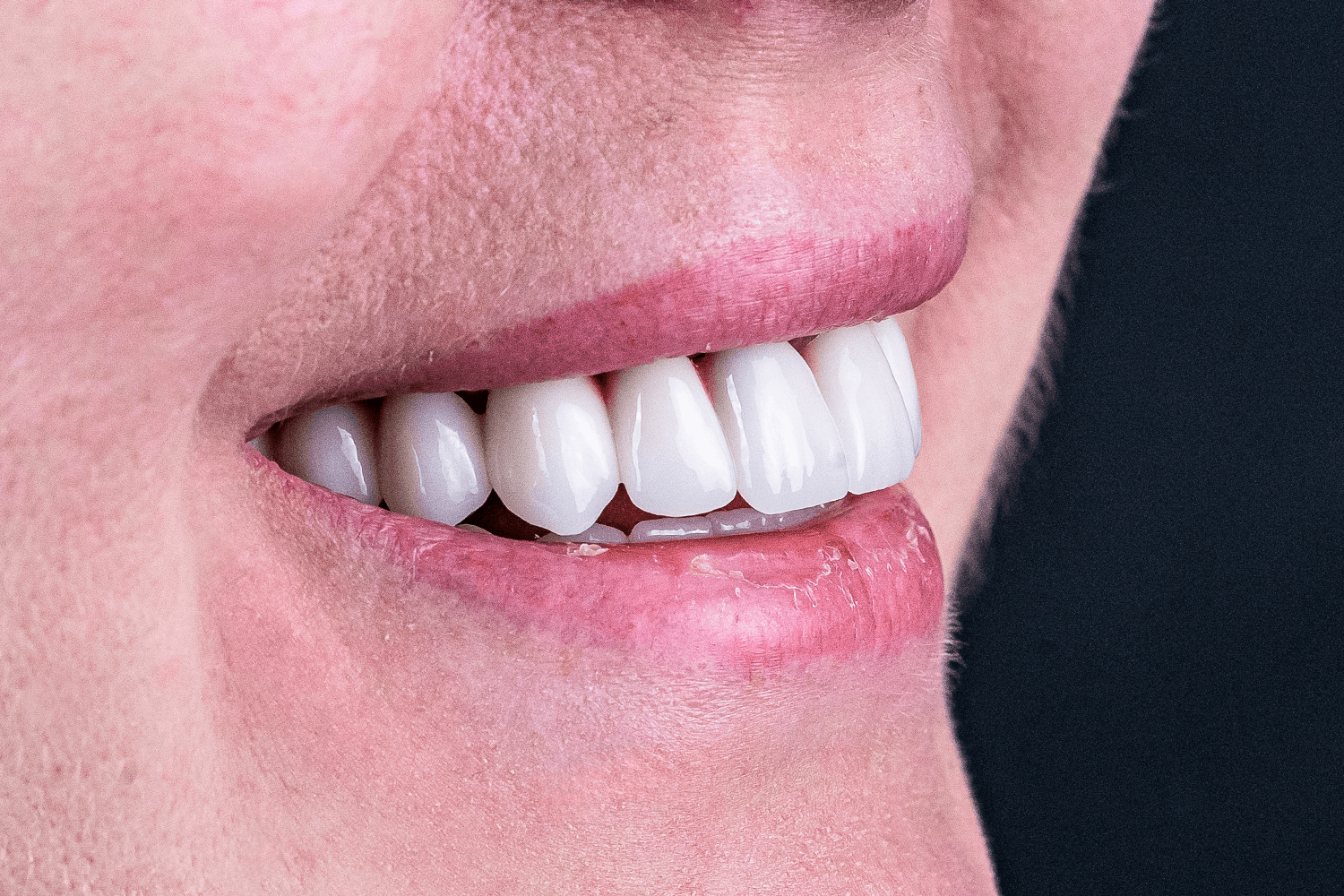 Імплантація та протезування при пародонтиті