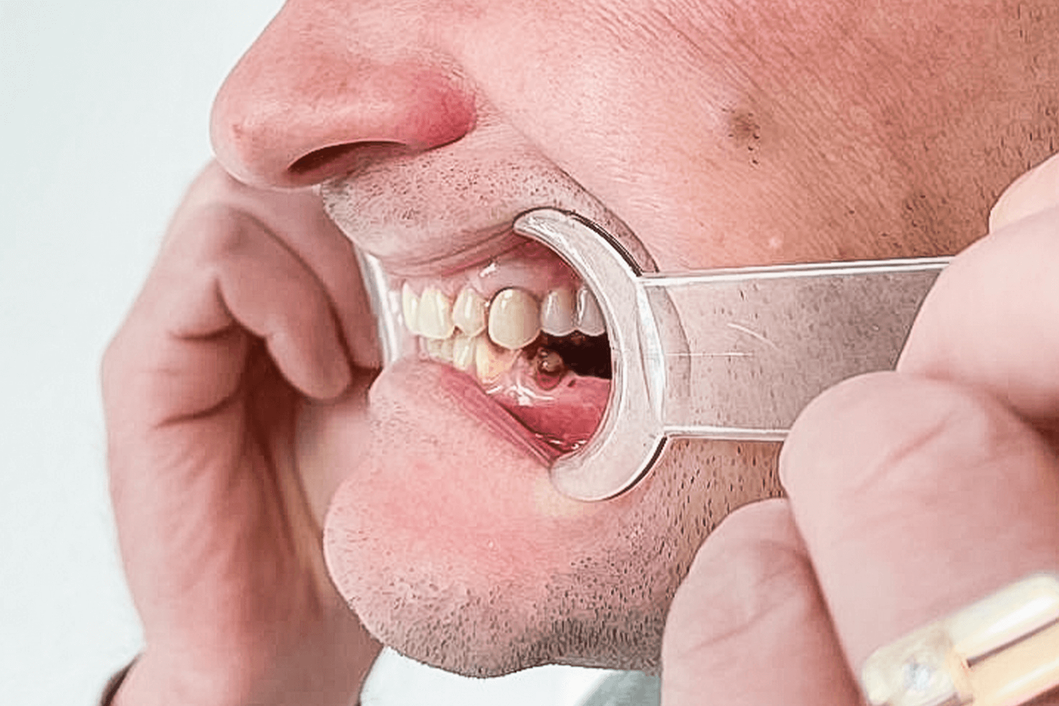 Замінили металокерамічні мости на цирконієві