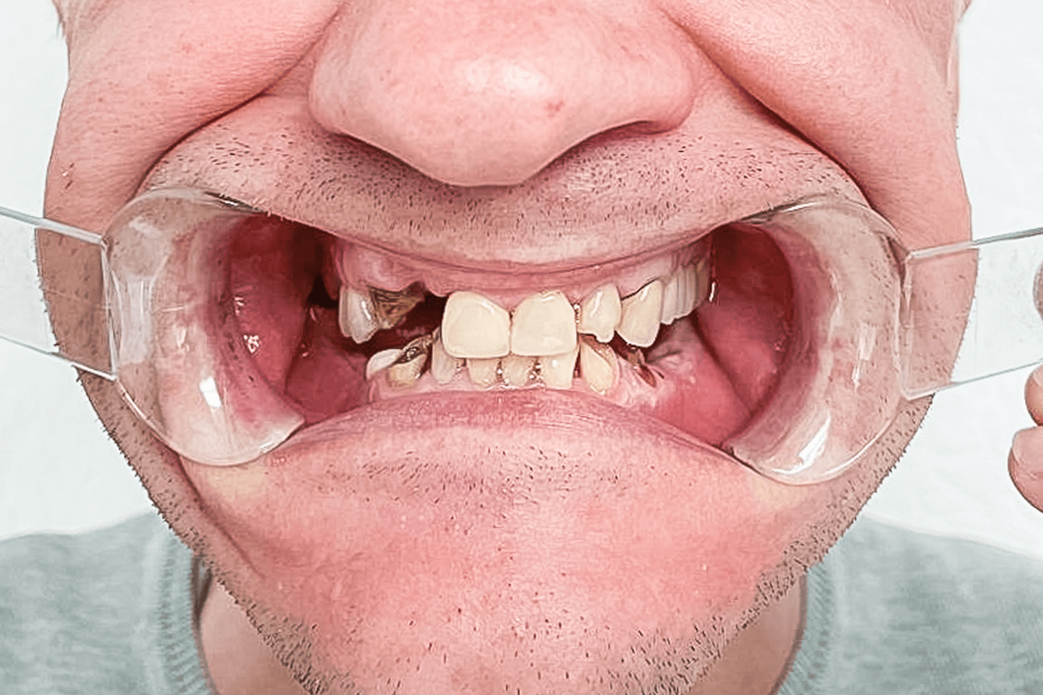 Замінили металокерамічні мости на цирконієві