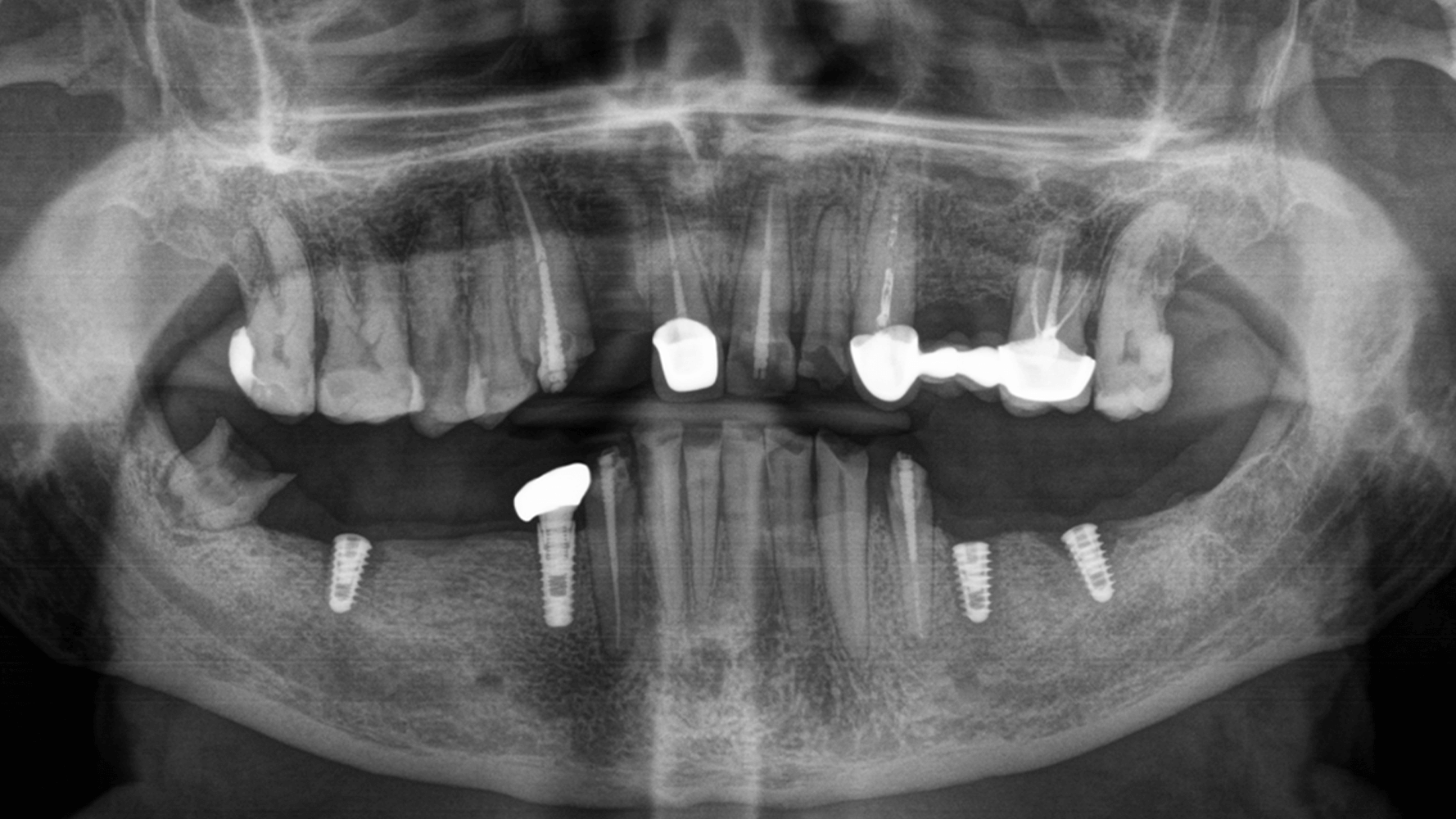 Замінили металокерамічні мости на цирконієві