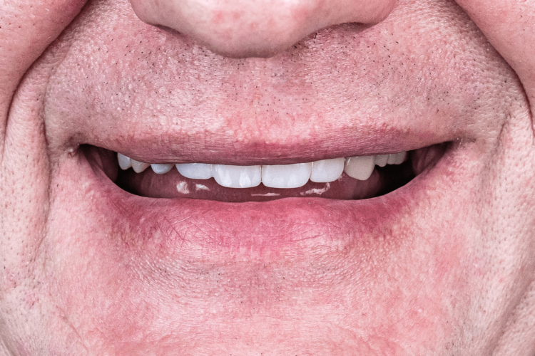 Заменили металлокерамические мосты на циркониевые