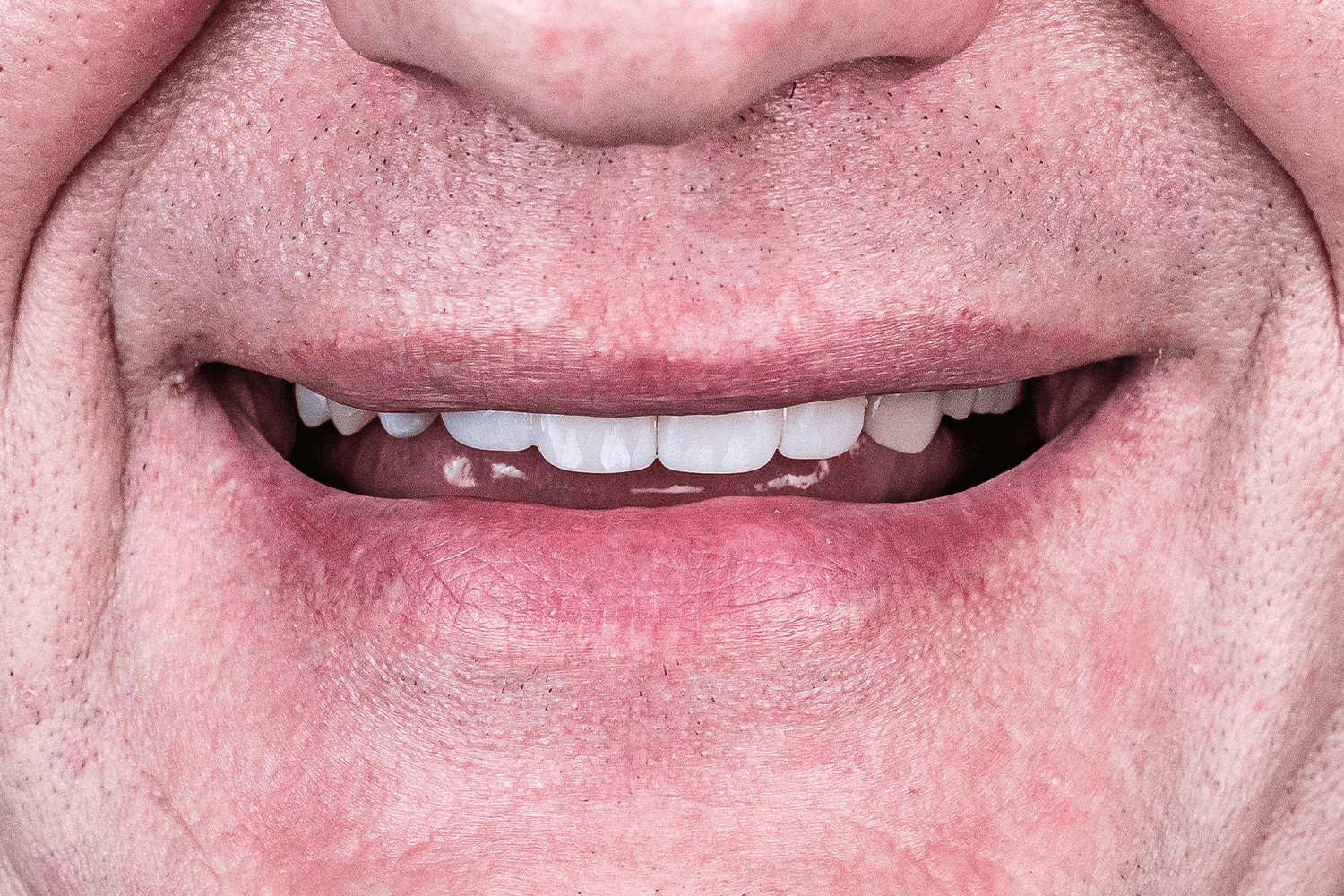 Замінили металокерамічні мости на цирконієві