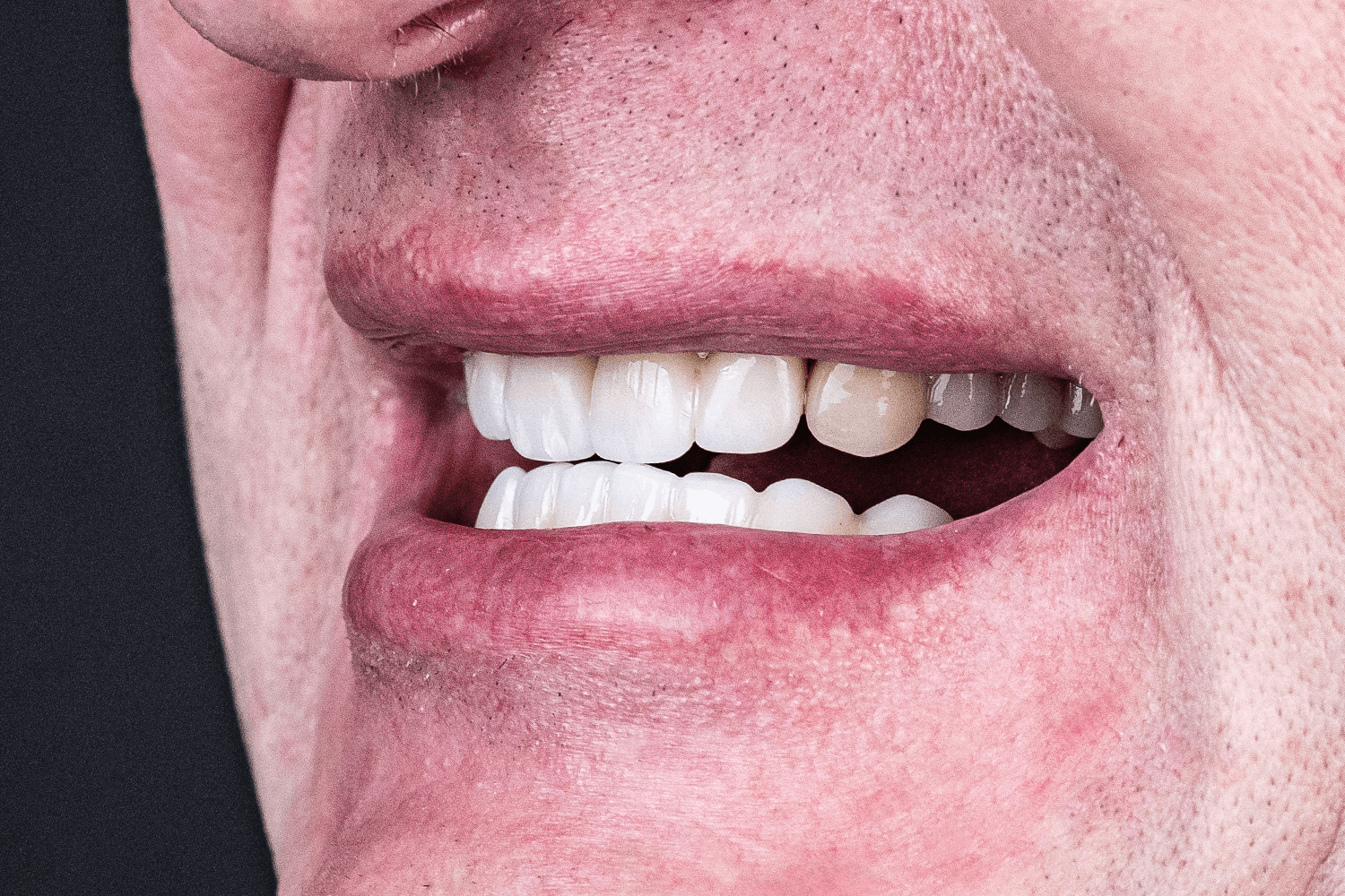 Замінили металокерамічні мости на цирконієві