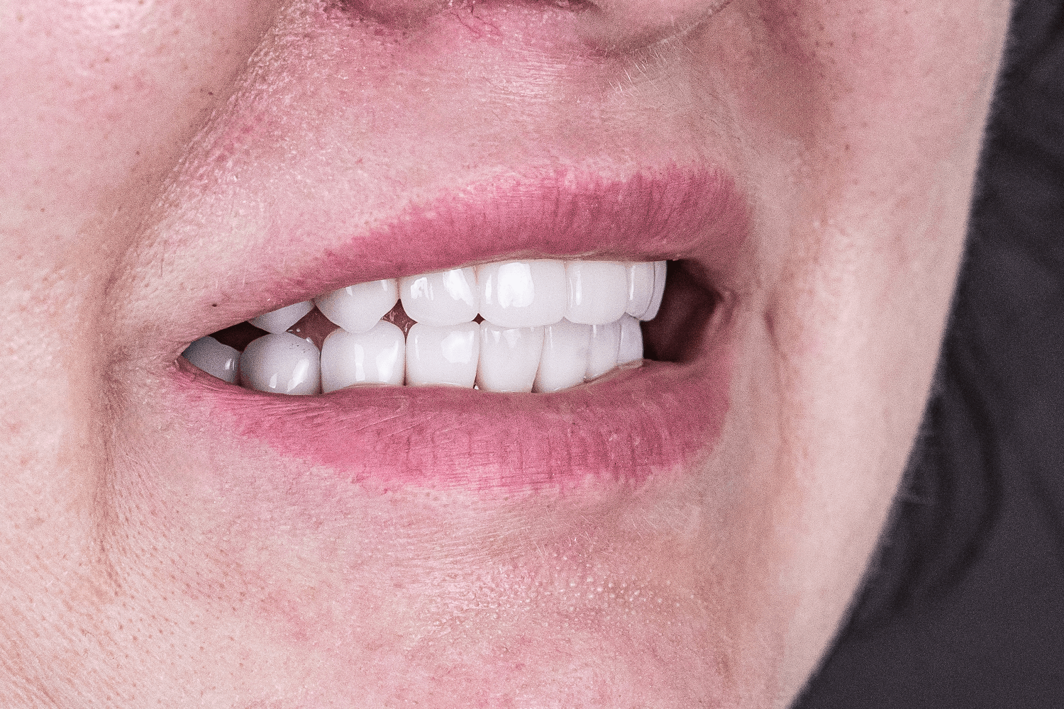 Відновлення зубів після травми отриманої в ДТП