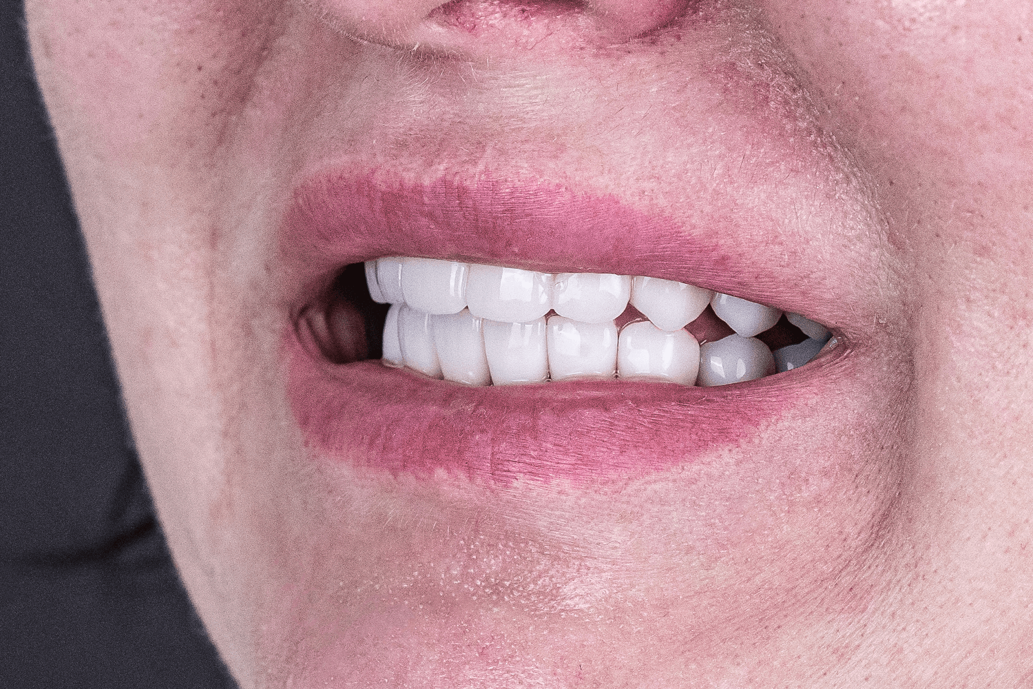 Відновлення зубів після травми отриманої в ДТП