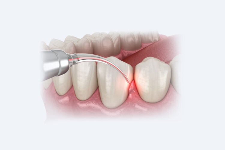 Пластика ясен