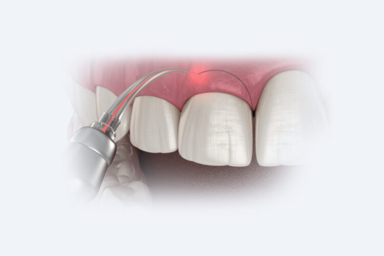 Пластика ясен