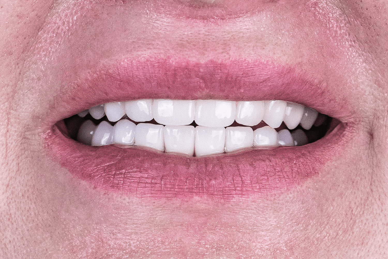 Відновлення зубів після травми отриманої в ДТП