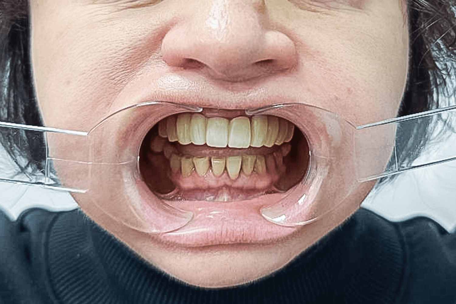 Відновлення зубів після травми отриманої в ДТП