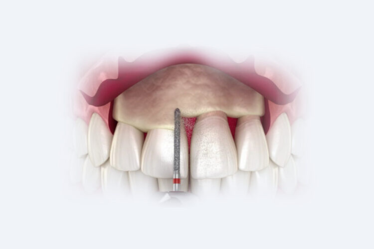 Пластика ясен