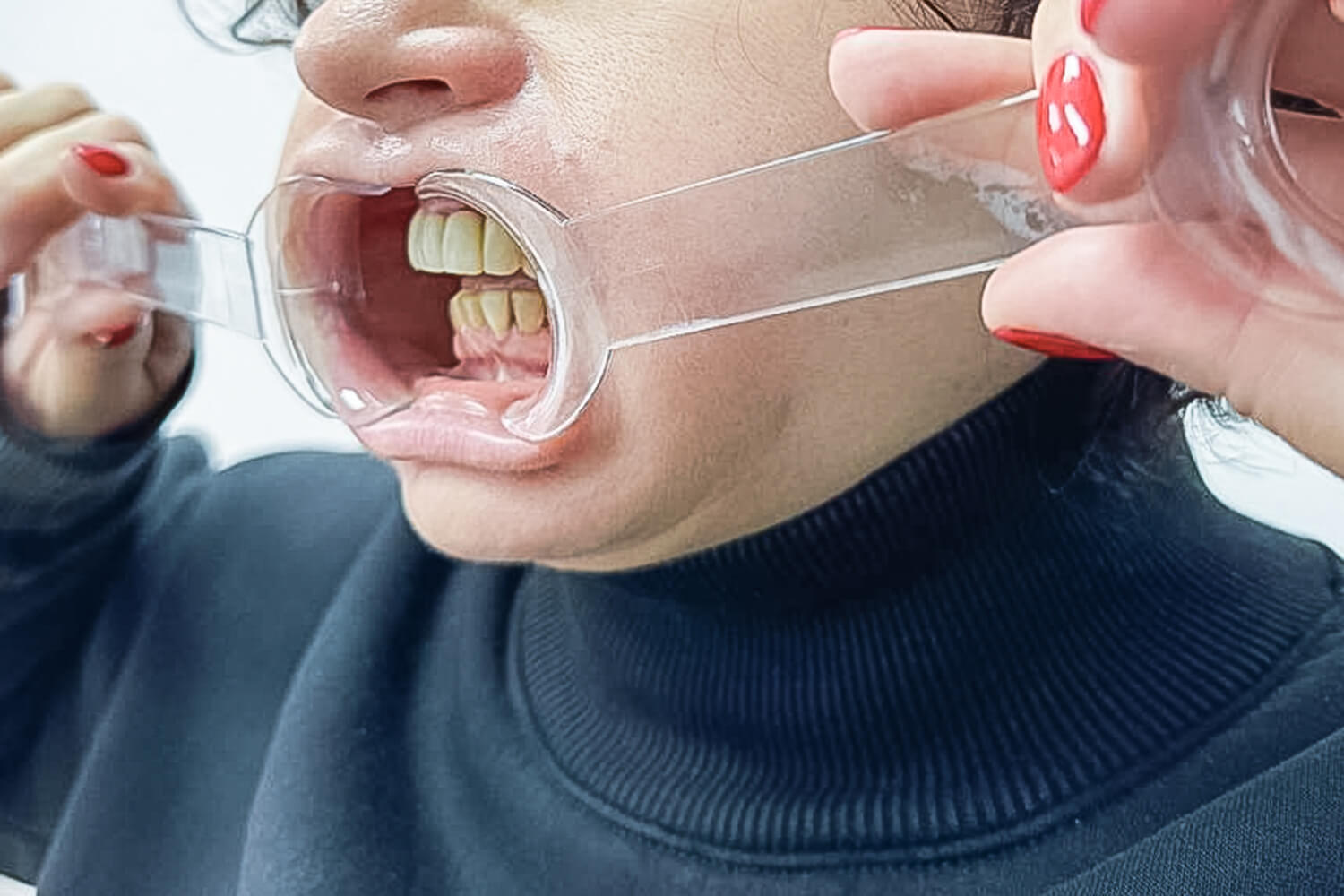 Відновлення зубів після травми отриманої в ДТП