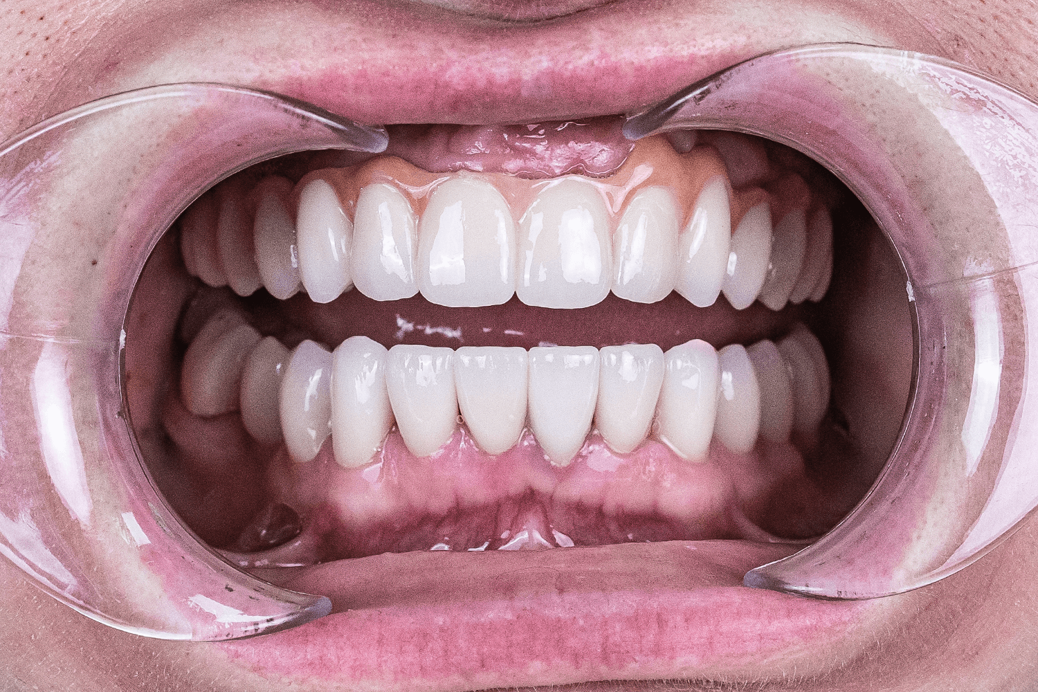 Відновлення зубів після травми отриманої в ДТП