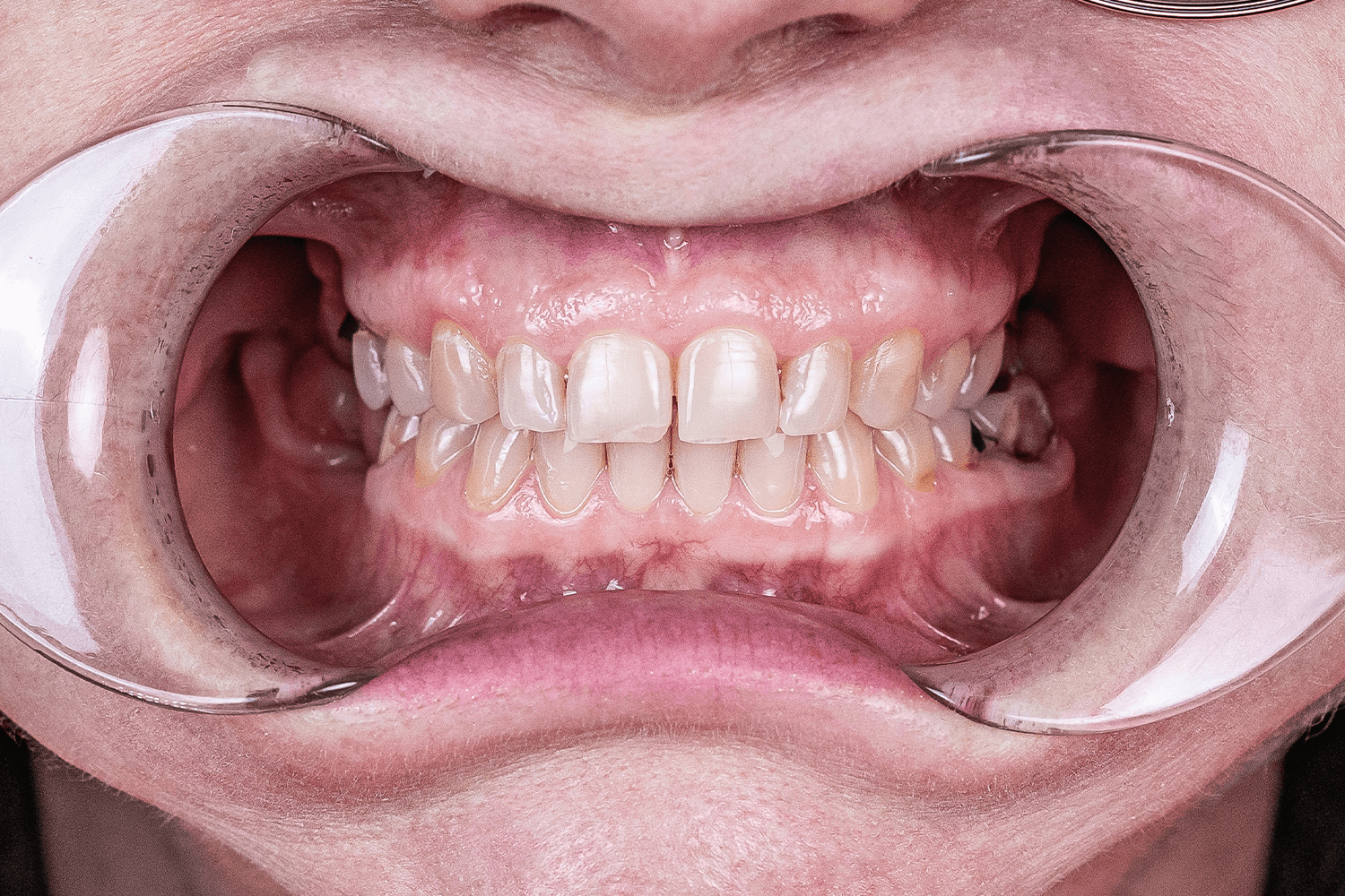 Імплантація й тотальне протезування зубів