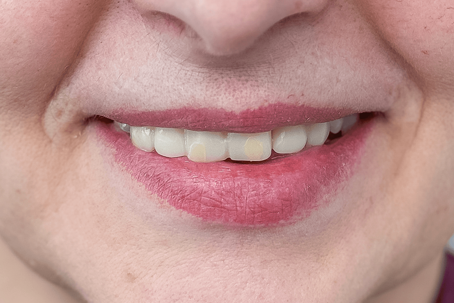 Встановили керамічні мости й коронки на імплантах