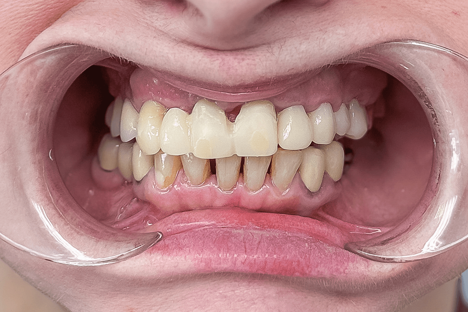 Встановили керамічні мости й коронки на імплантах