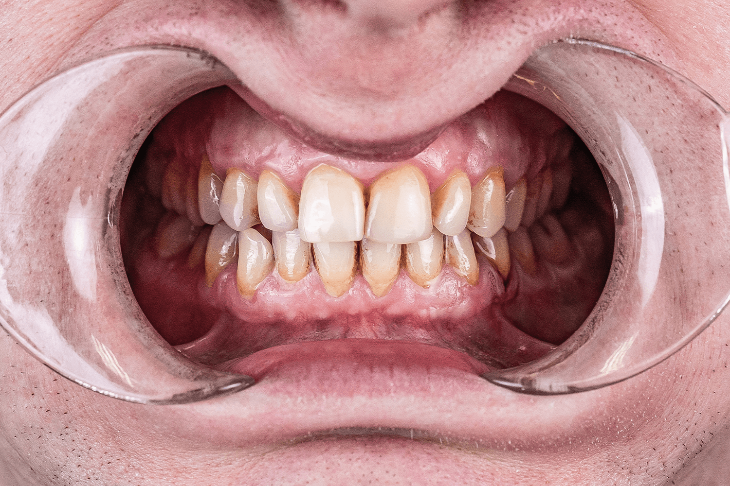 Тотальне протезування зубів керамічними коронками e.max