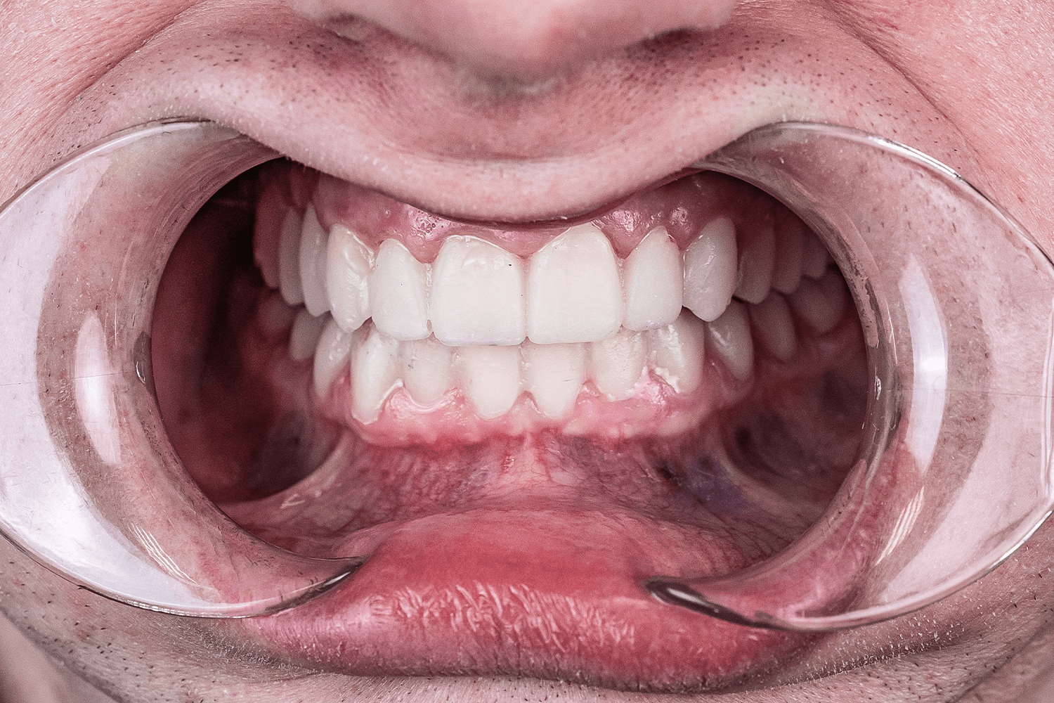 Тотальне протезування зубів керамічними коронками e.max