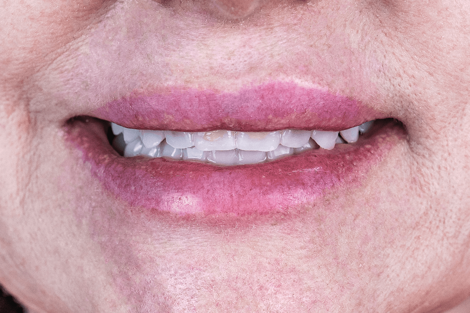 Імплантація й тотальне протезування зубів