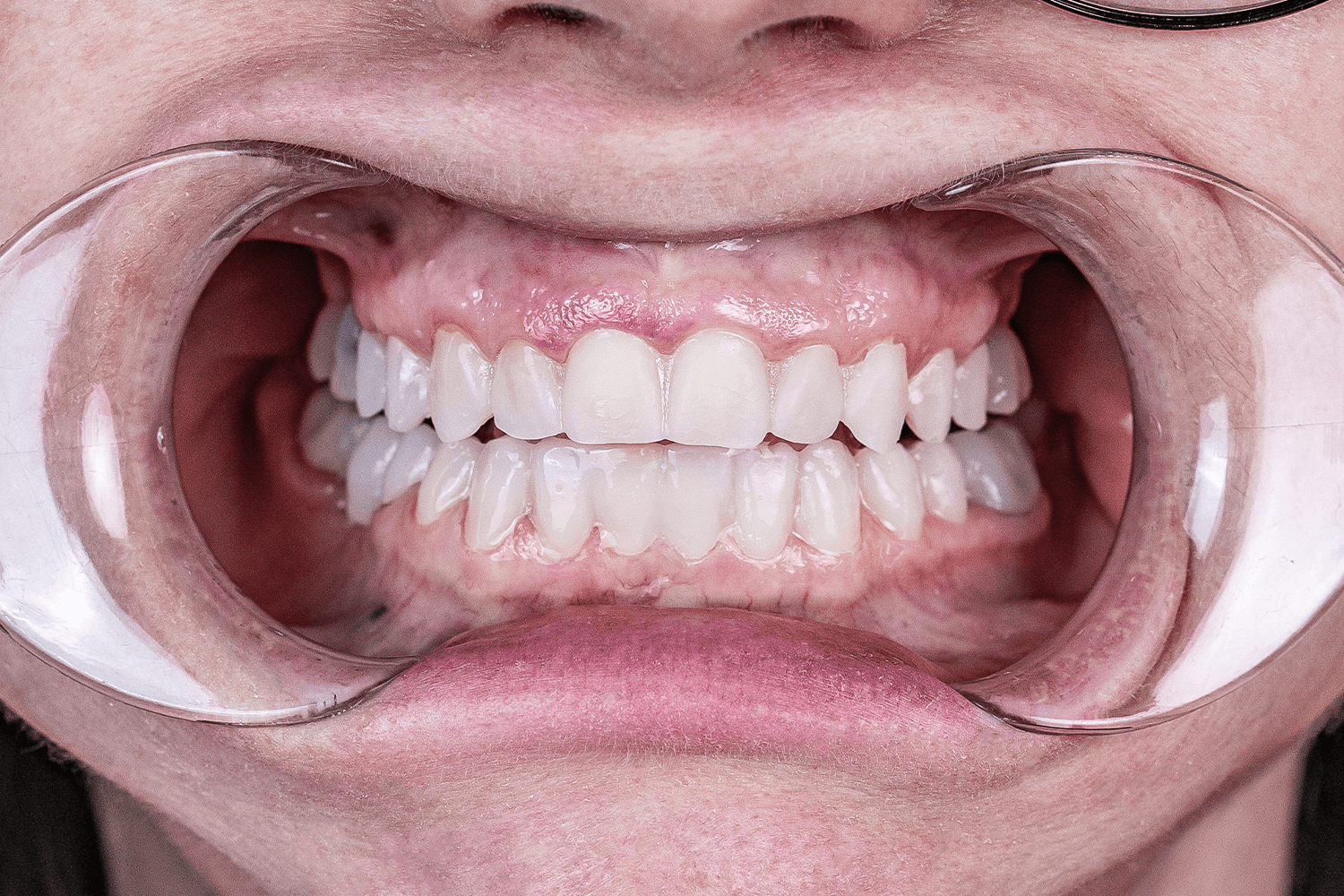 Імплантація й тотальне протезування зубів