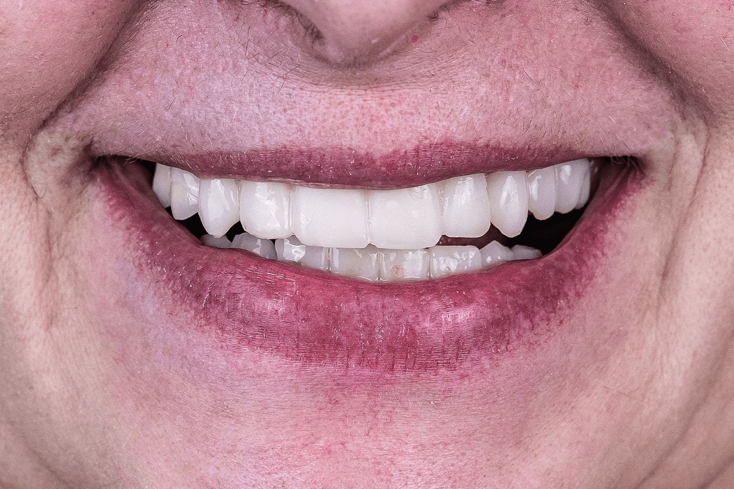 Встановили керамічні мости й коронки на імплантах