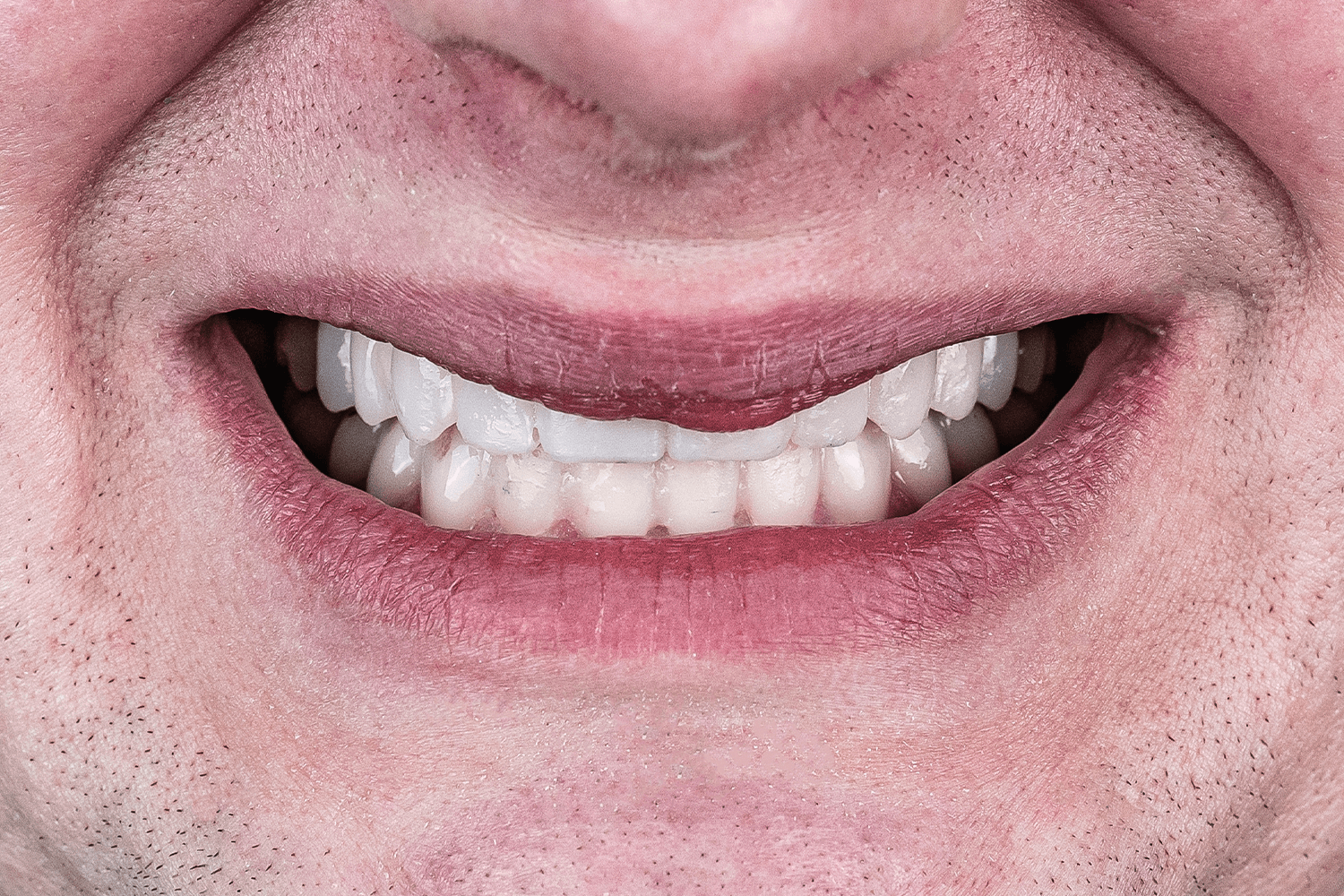 Тотальне протезування зубів керамічними коронками e.max