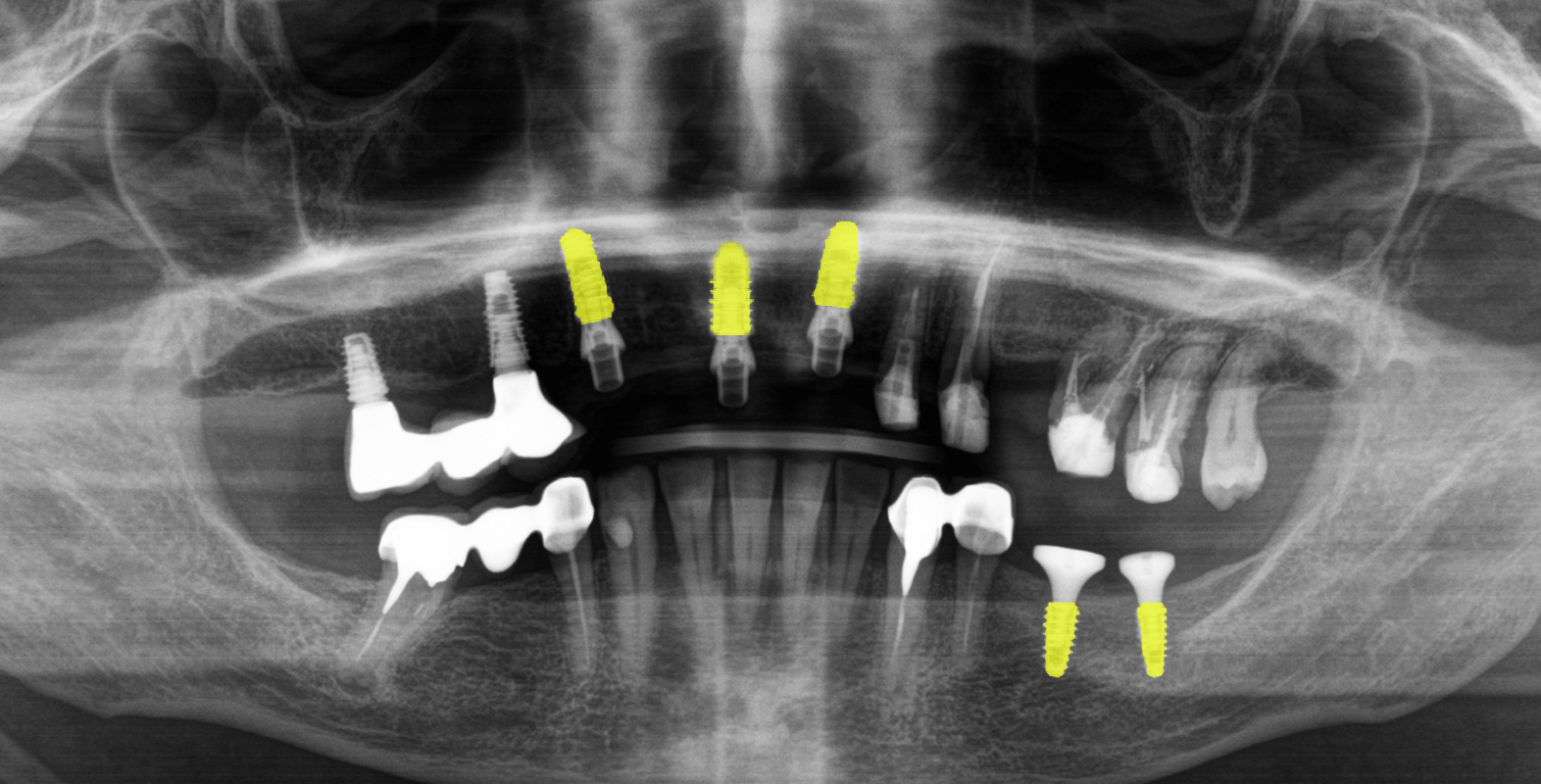 Встановили керамічні мости й коронки на імплантах