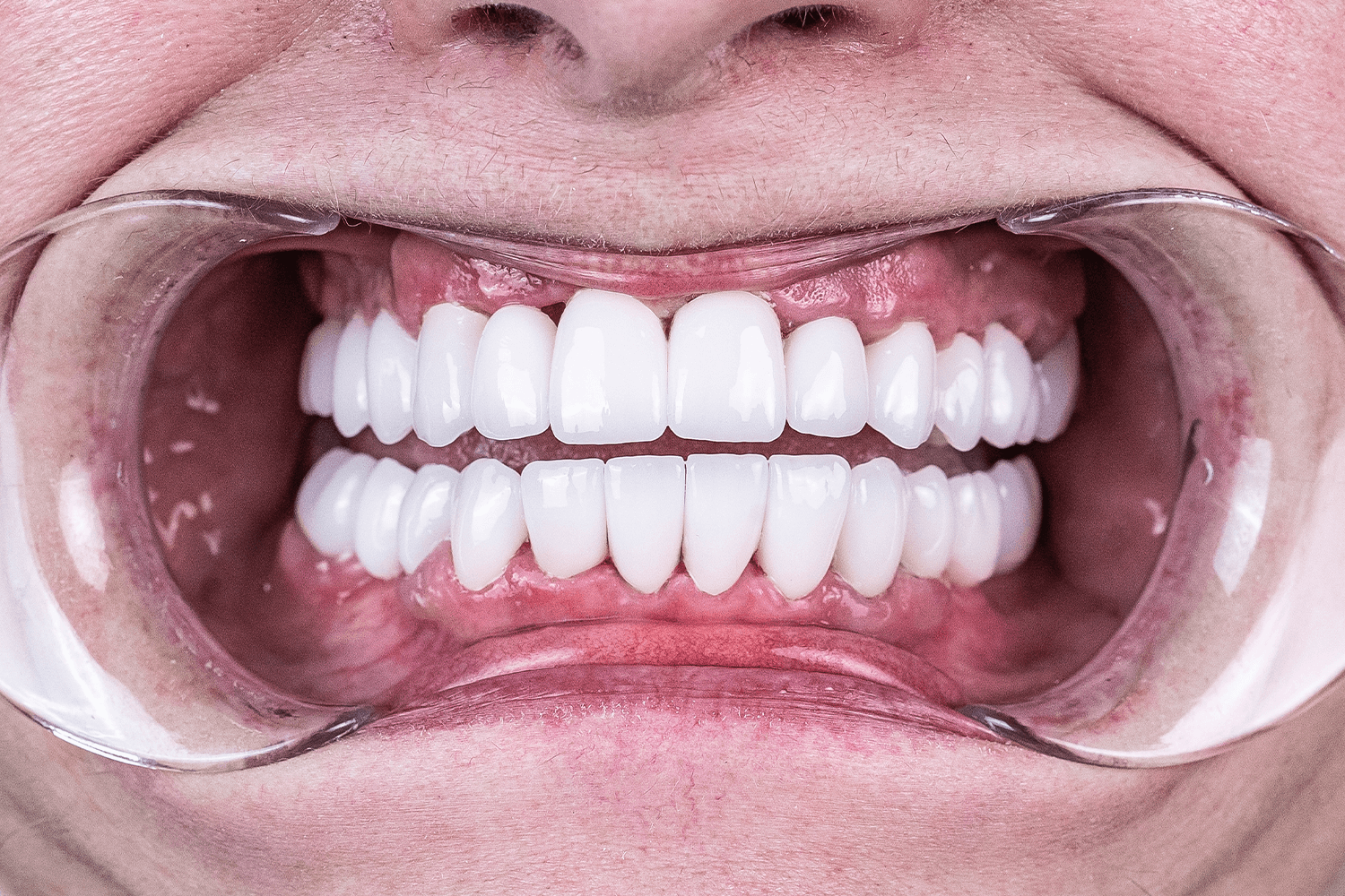 Встановили керамічні мости й коронки на імплантах