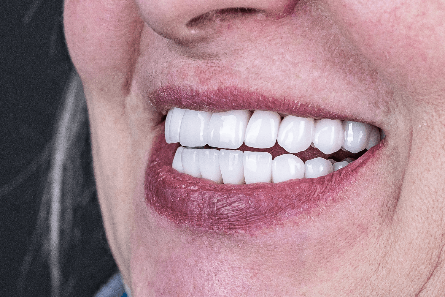 Встановили керамічні мости й коронки на імплантах