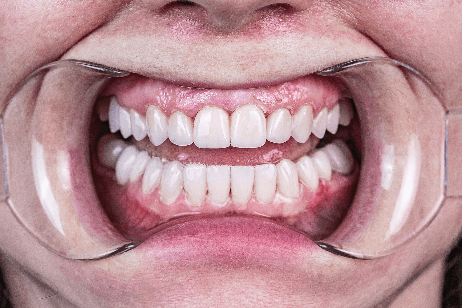 Імплантація й тотальне протезування зубів