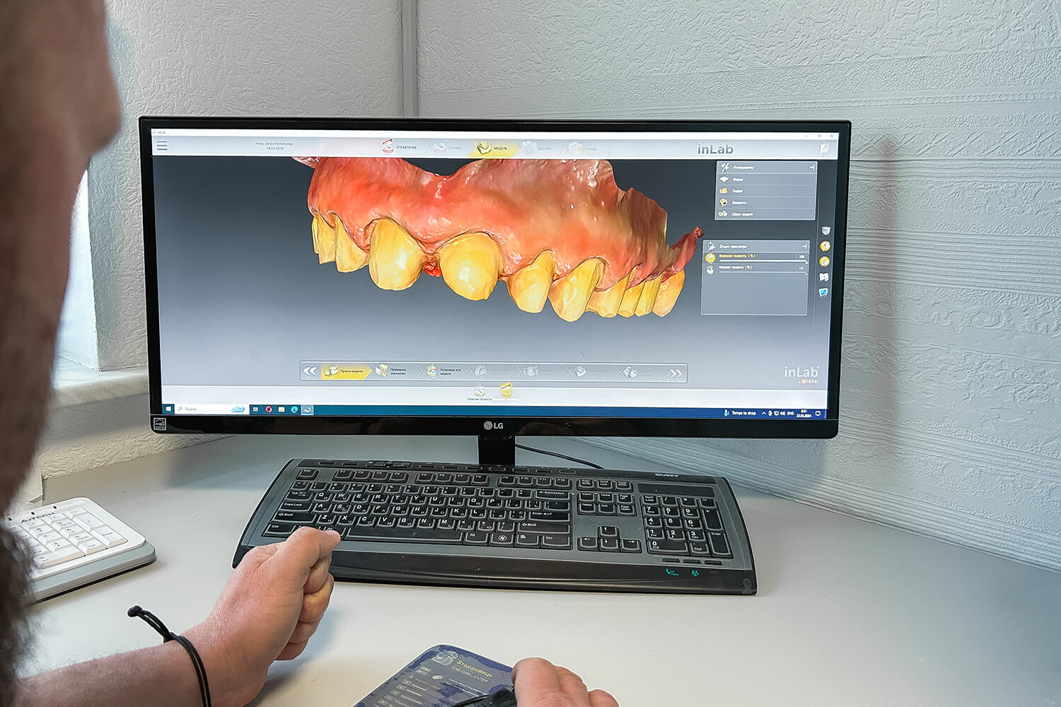 Тотальне протезування зубів керамічними коронками e.max