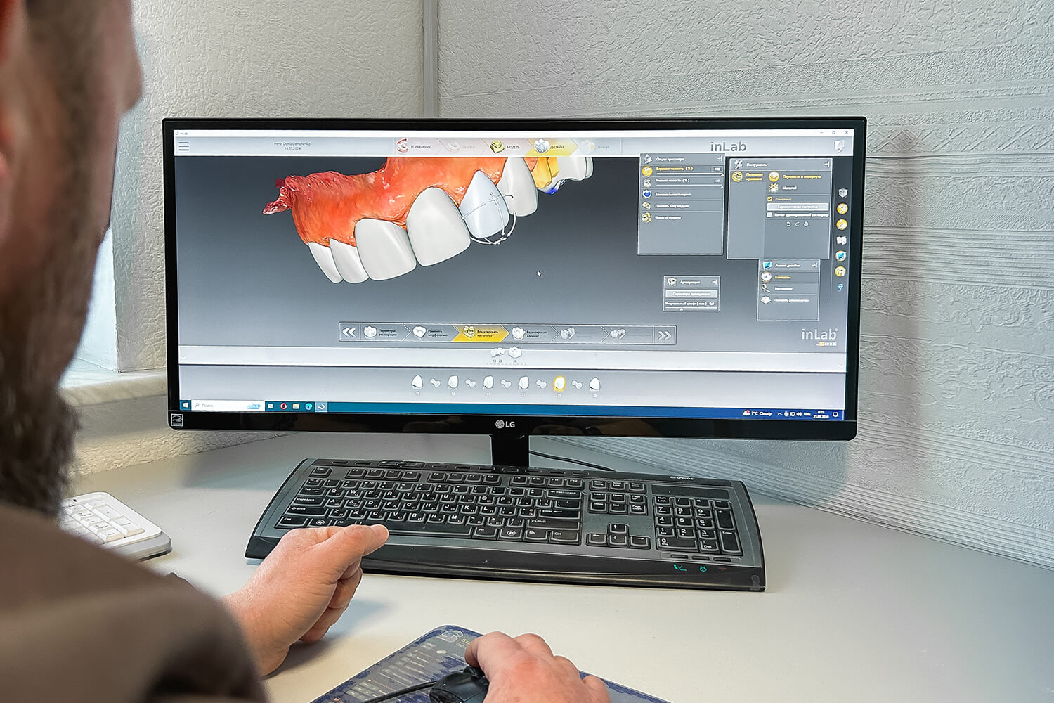 Тотальне протезування зубів керамічними коронками e.max