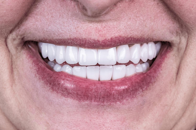 Установили керамические мосты и коронки на имплантах