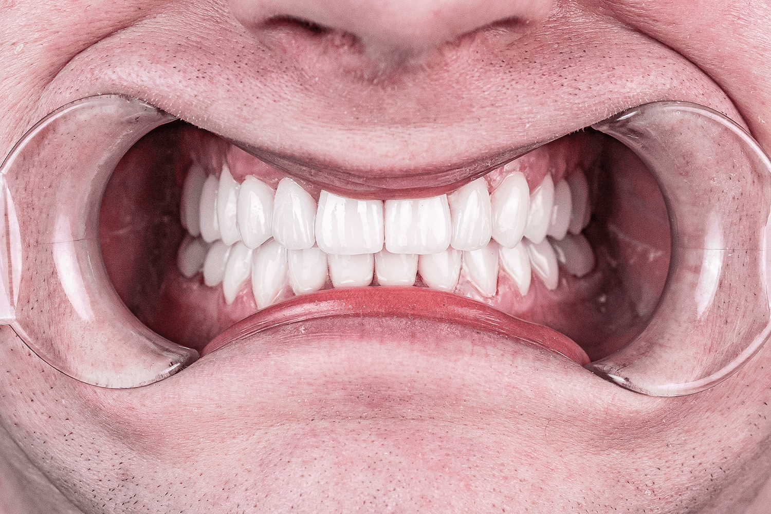 Тотальне протезування зубів керамічними коронками e.max