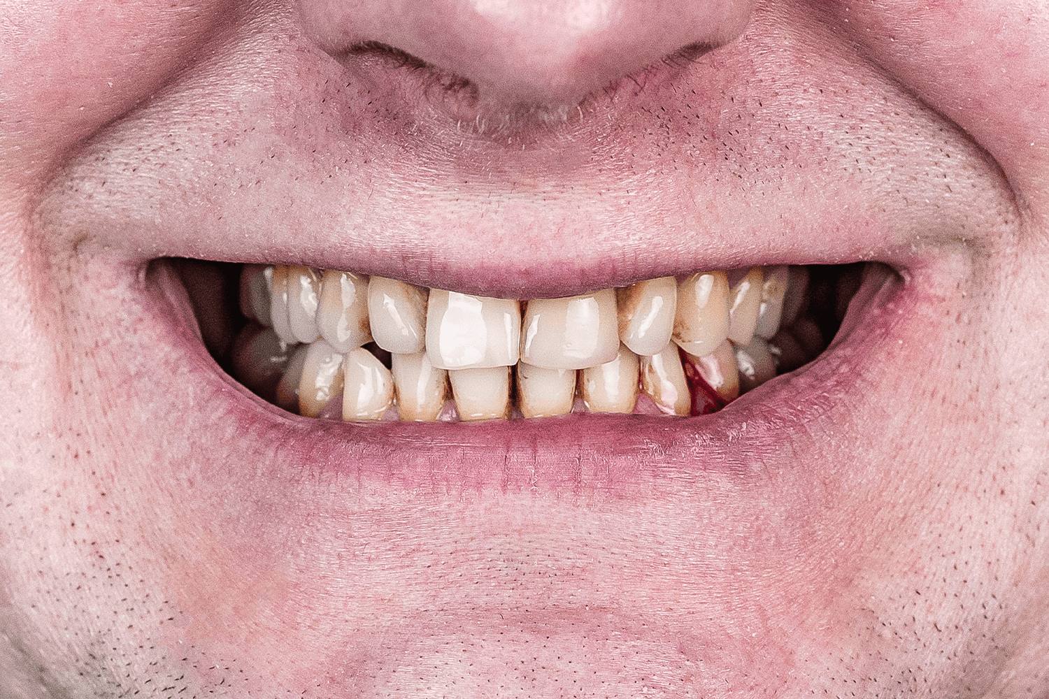 Тотальне протезування зубів керамічними коронками e.max