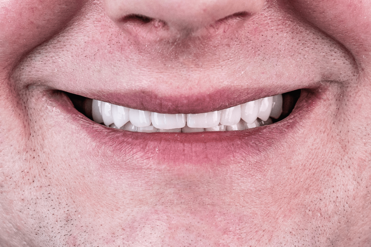 Тотальное протезирование зубов керамическими коронками e.max