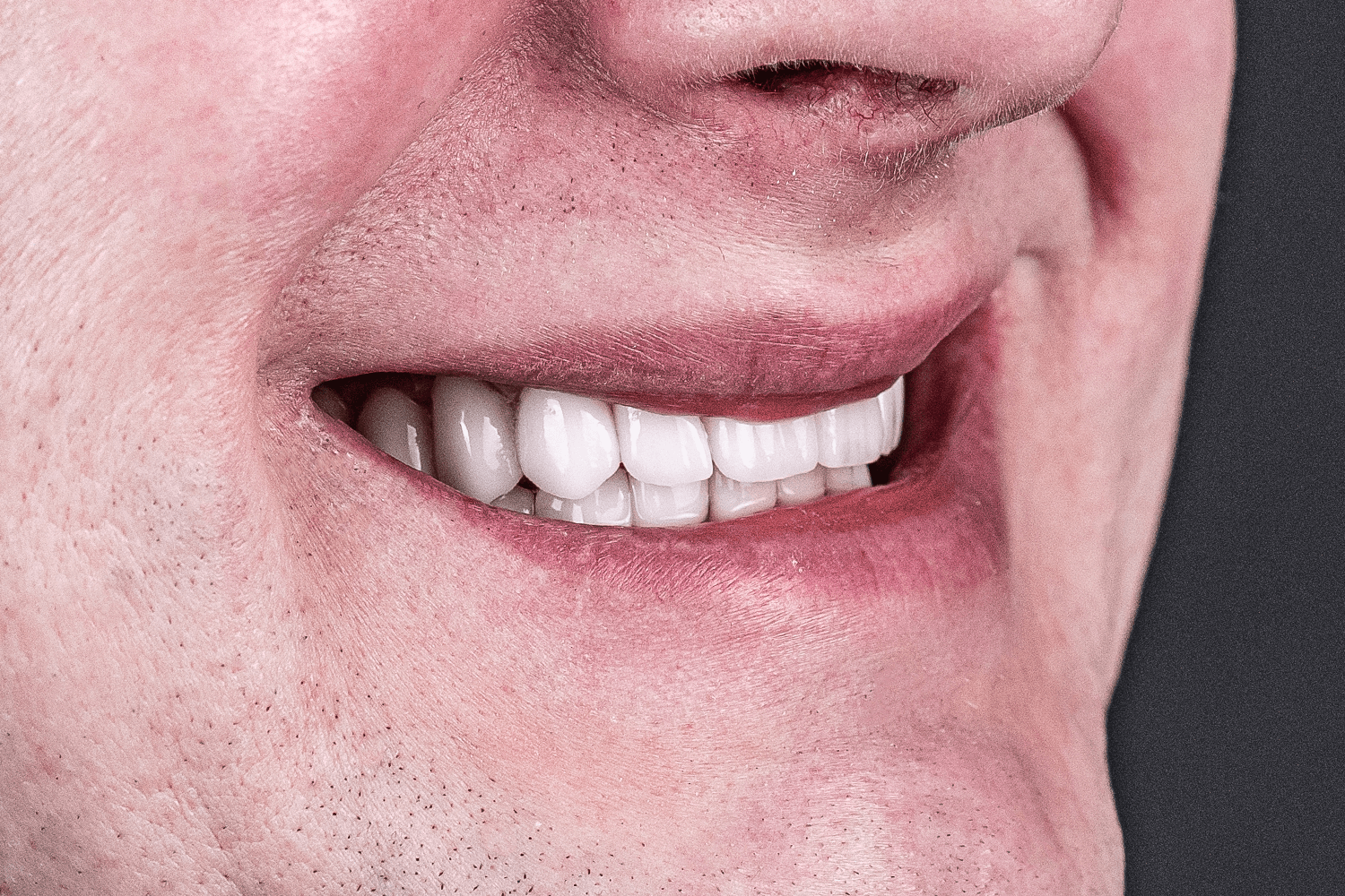 Тотальне протезування зубів керамічними коронками e.max