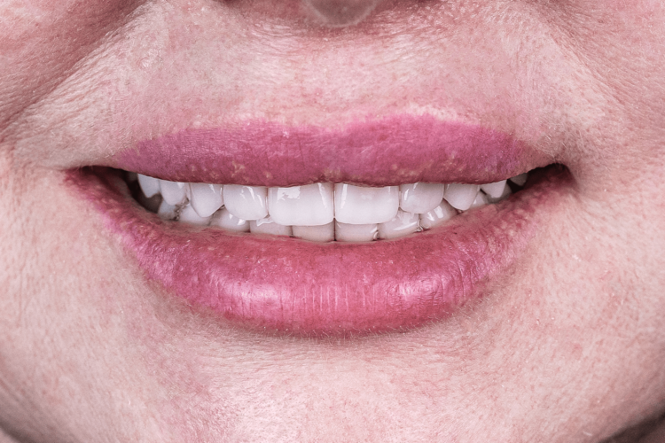 Имплантация и тотальное протезирование зубов