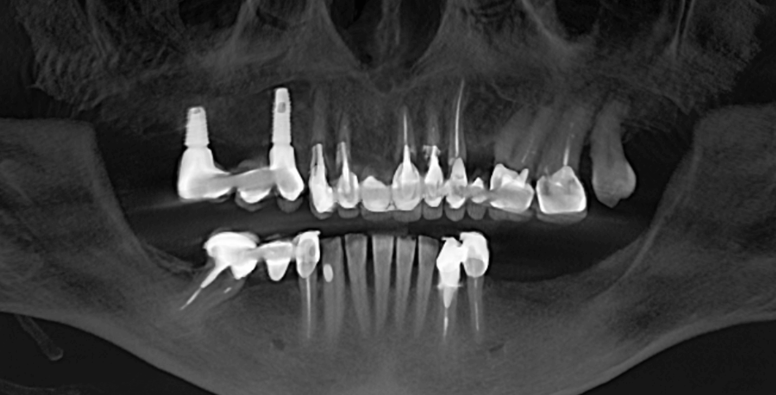 Встановили керамічні мости й коронки на імплантах