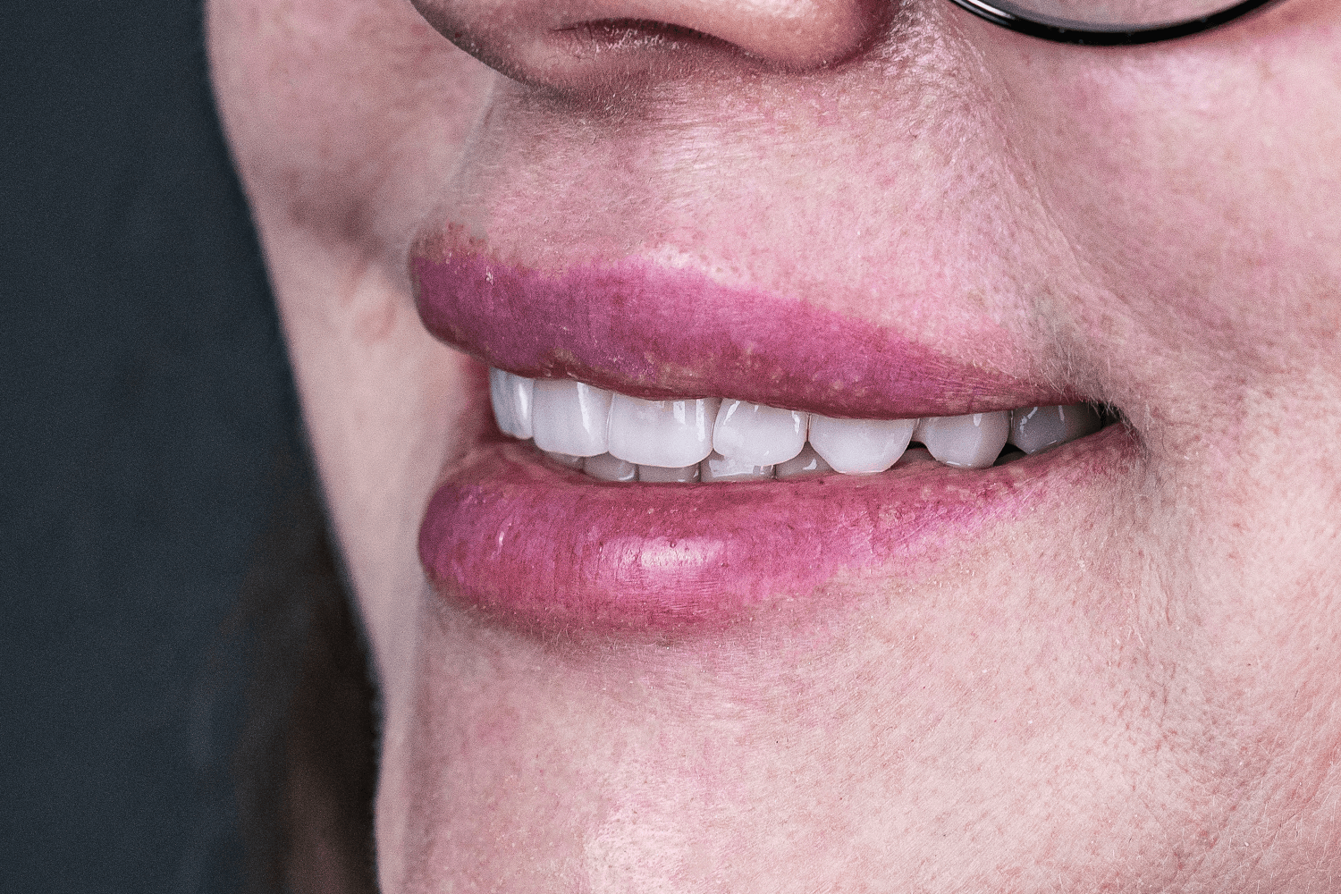 Імплантація й тотальне протезування зубів