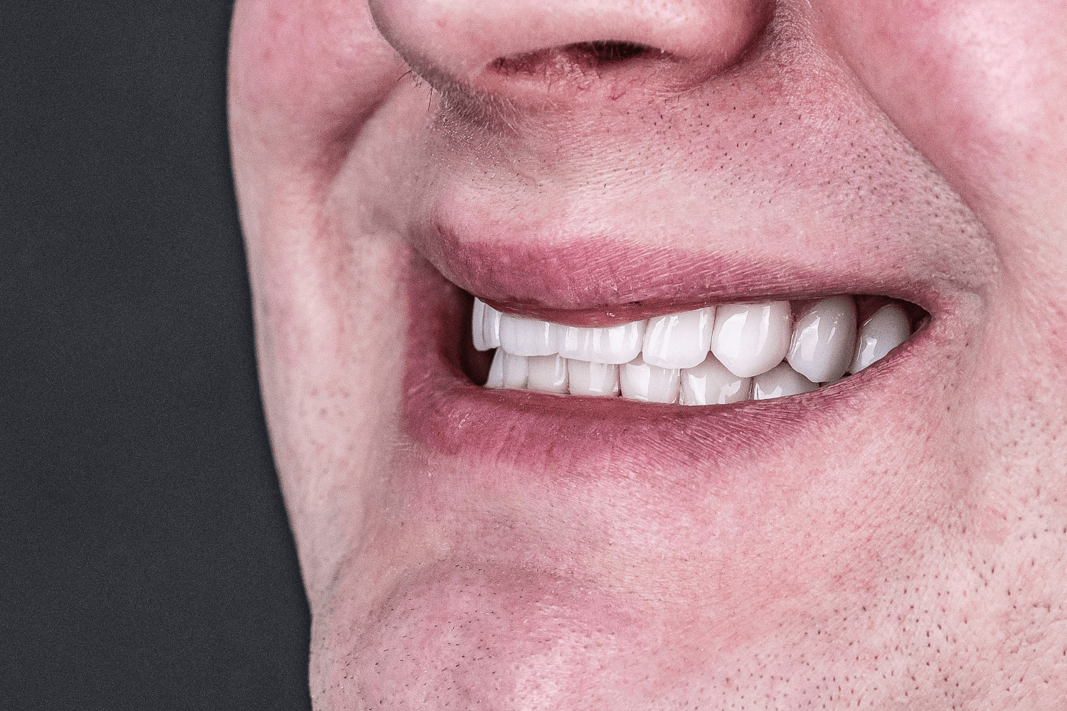 Тотальне протезування зубів керамічними коронками e.max