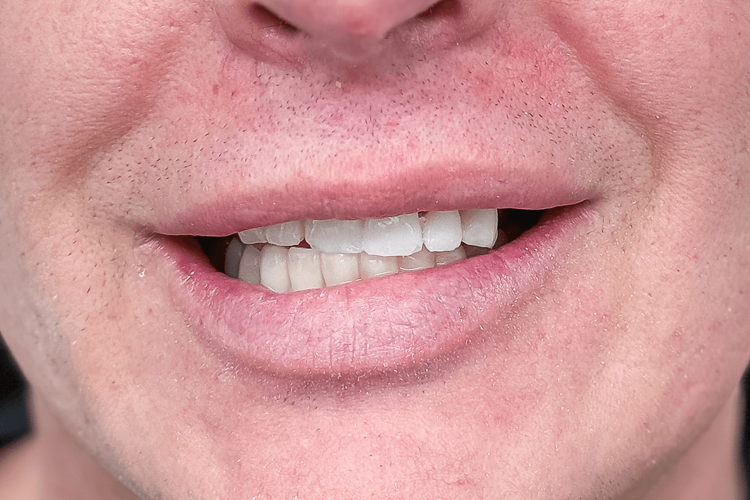 Тотальне протезування коронками на імплантах Straumann