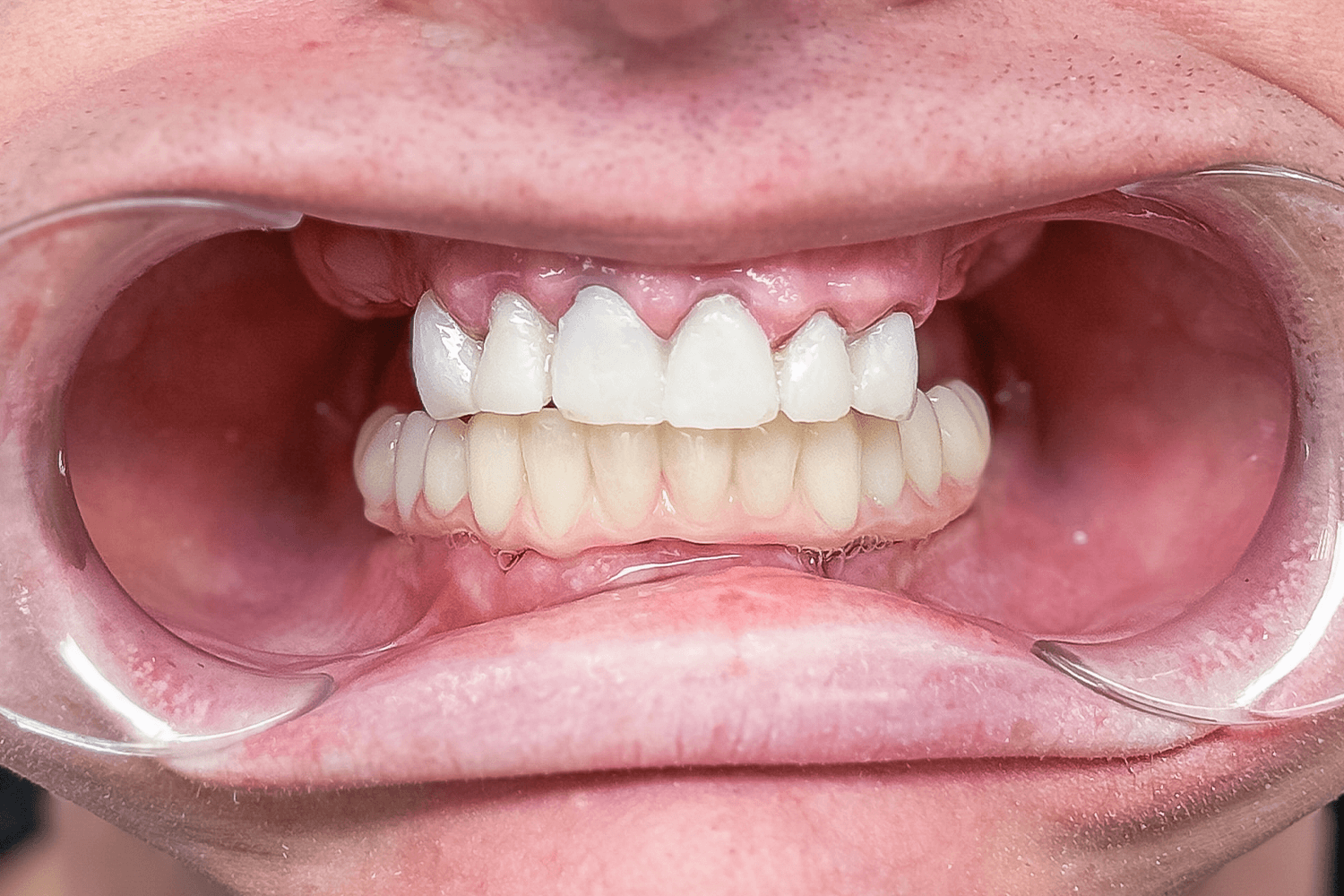 Тотальне протезування коронками на імплантах Straumann