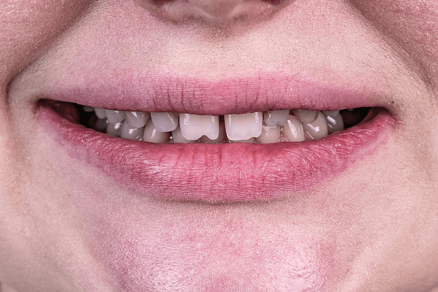 Тотальне протезування вінірами й коронками e.max