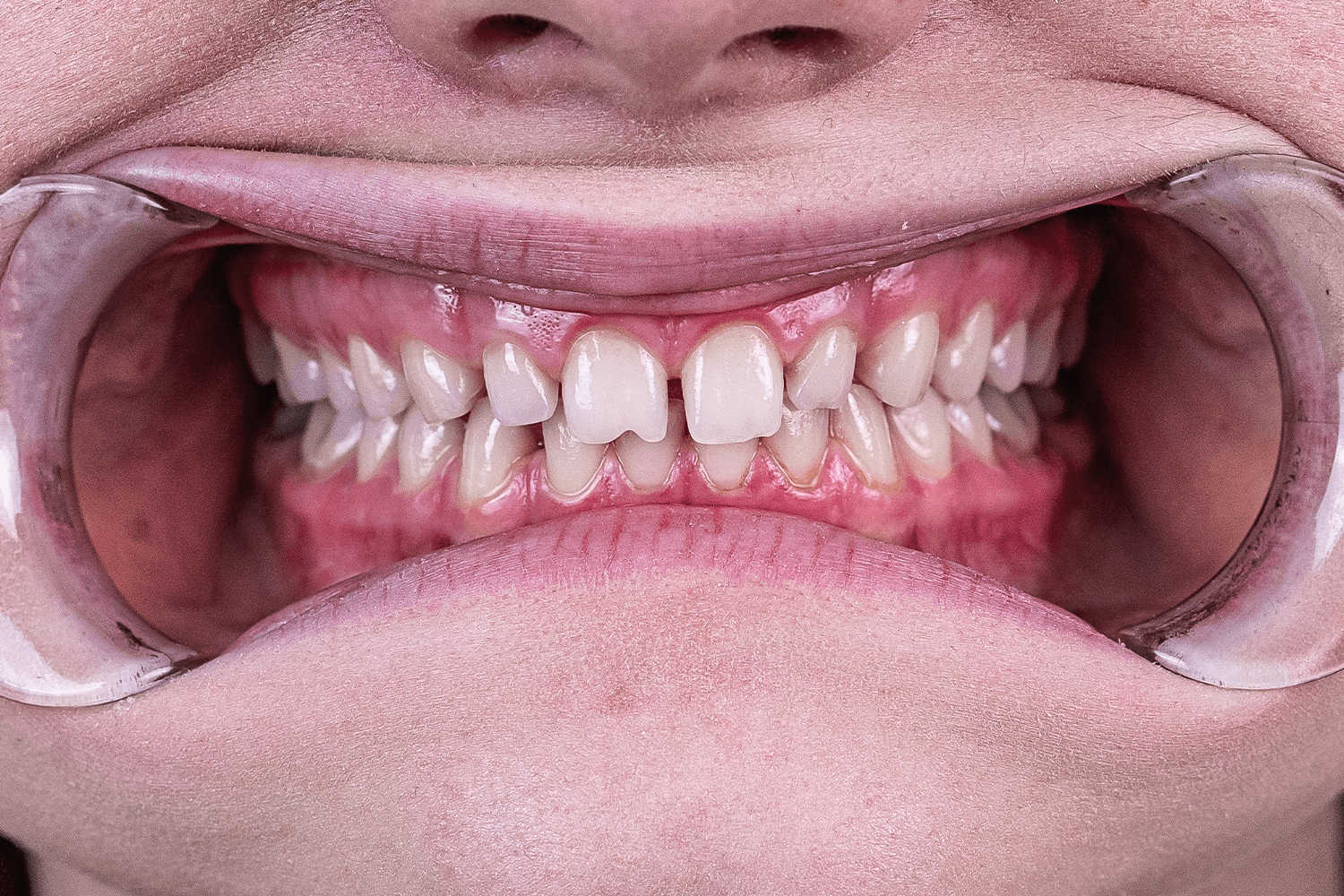 Тотальне протезування вінірами й коронками e.max